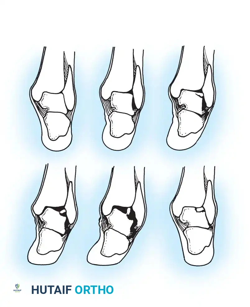 INTERNAL DERANGEMENTS Surgical Diagram