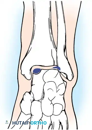 INTERNAL DERANGEMENTS Surgical Diagram
