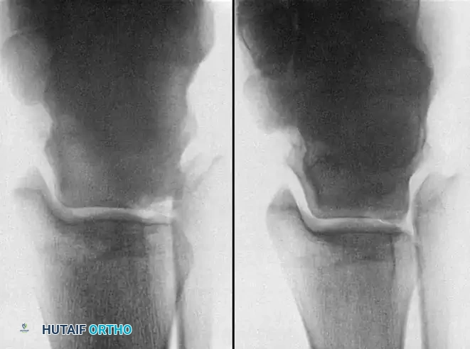 INTERNAL DERANGEMENTS Surgical Diagram