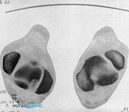 INTERNAL DERANGEMENTS Surgical Diagram