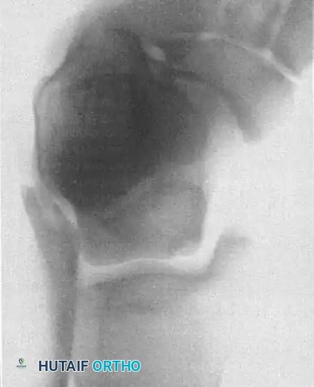 INTERNAL DERANGEMENTS Surgical Diagram