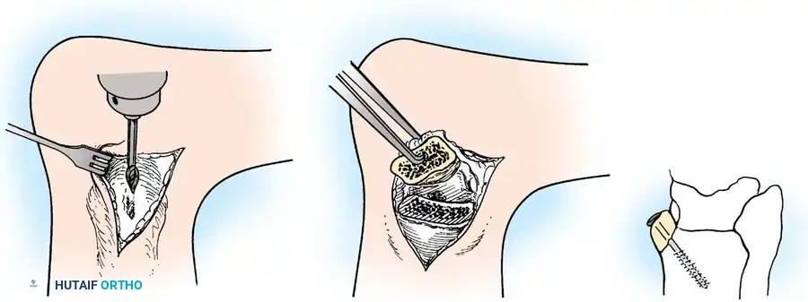 INTERNAL DERANGEMENTS Surgical Diagram