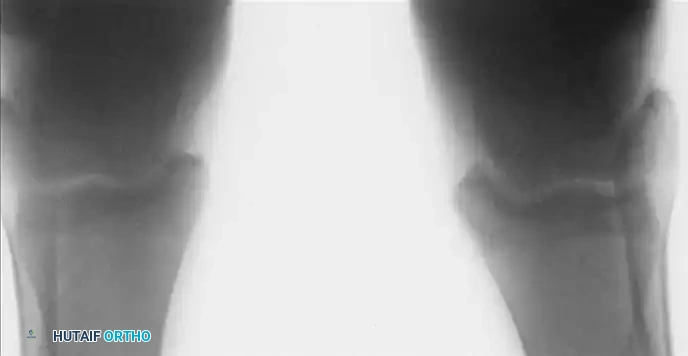 INTERNAL DERANGEMENTS Surgical Diagram