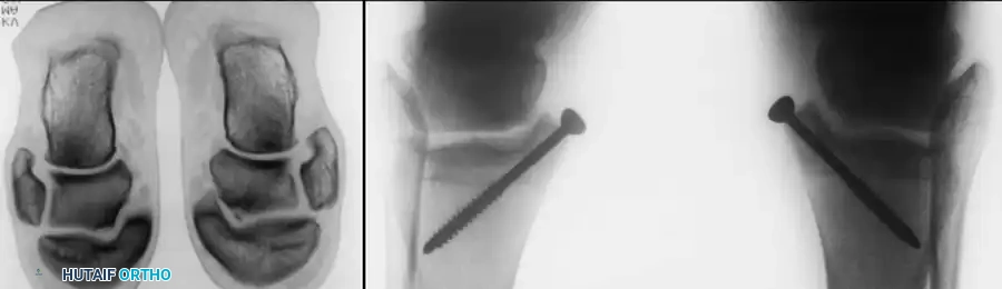 INTERNAL DERANGEMENTS Surgical Diagram