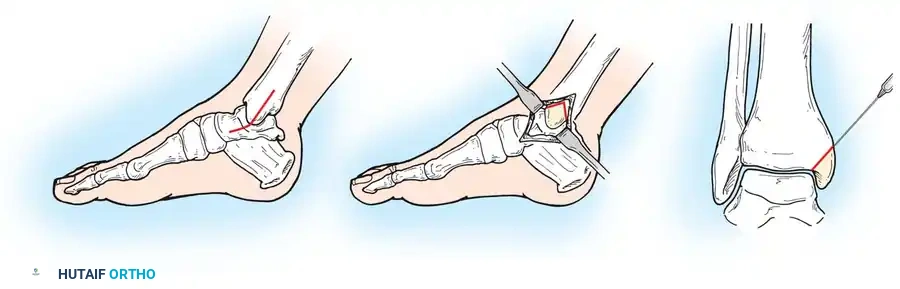 INTERNAL DERANGEMENTS Surgical Diagram