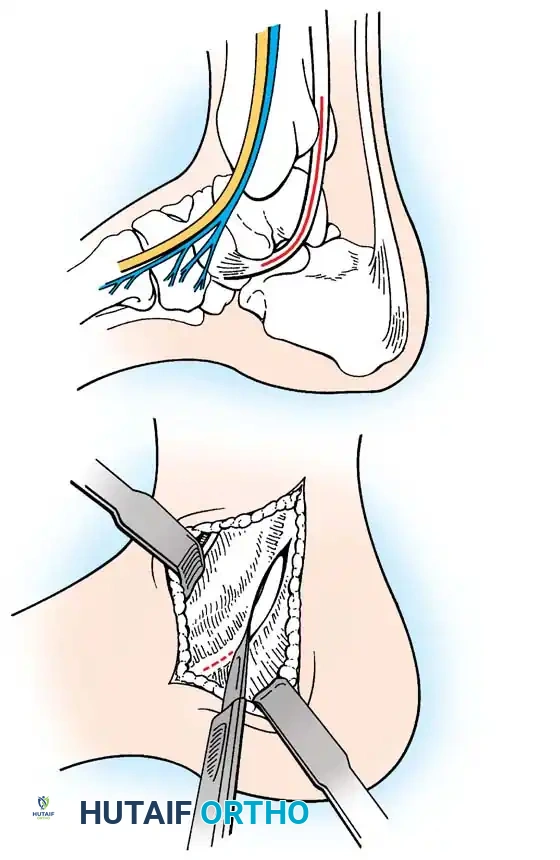 INTERNAL DERANGEMENTS Surgical Diagram
