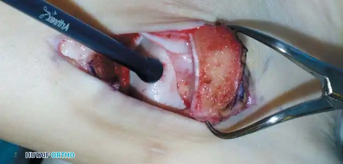 INTERNAL DERANGEMENTS Surgical Diagram