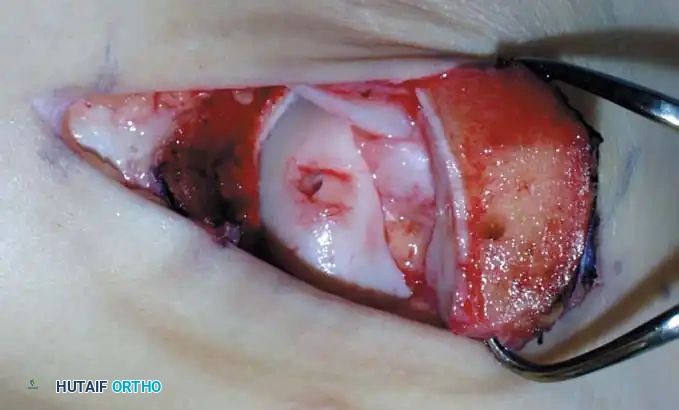 INTERNAL DERANGEMENTS Surgical Diagram