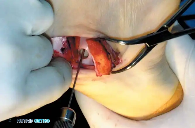 INTERNAL DERANGEMENTS Surgical Diagram