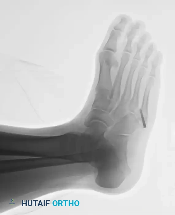 INTERNAL FIXATION WITH A MALLEOLAR SCREW Surgical Diagram