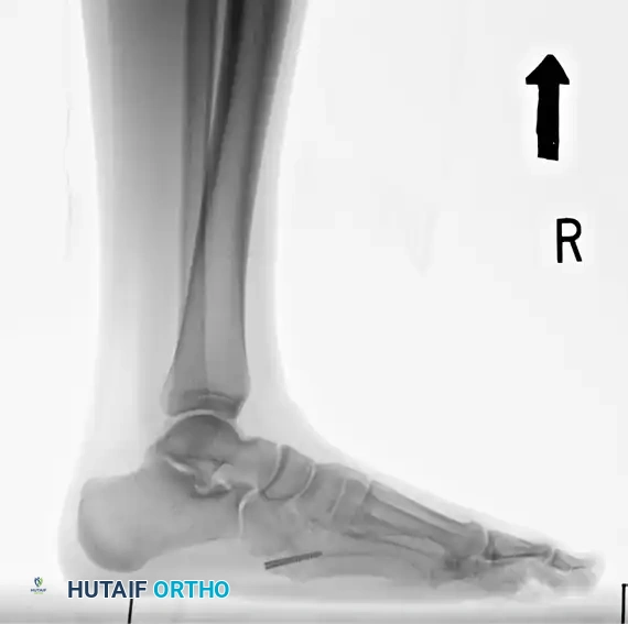 INTERNAL FIXATION WITH A MALLEOLAR SCREW Surgical Diagram