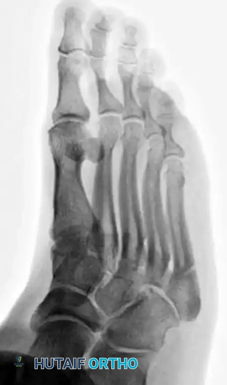 INTERNAL FIXATION WITH A MALLEOLAR SCREW Surgical Diagram