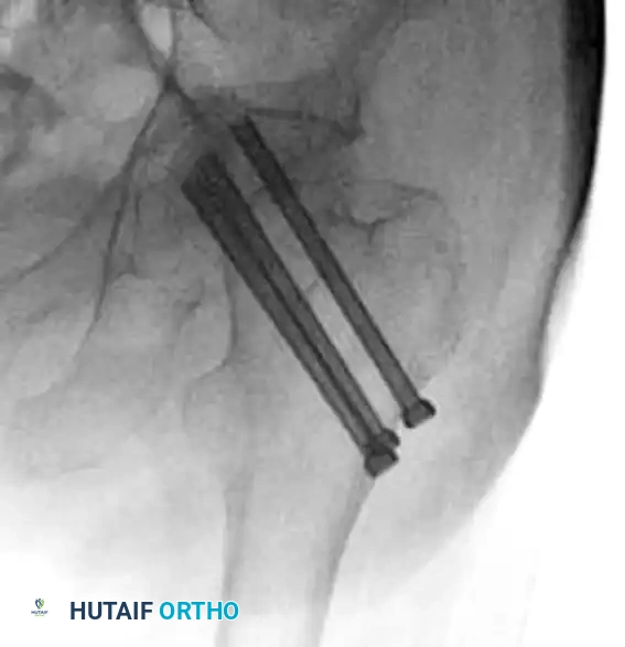 INTERTROCHANTERIC FEMORAL FRACTURES Surgical Diagram