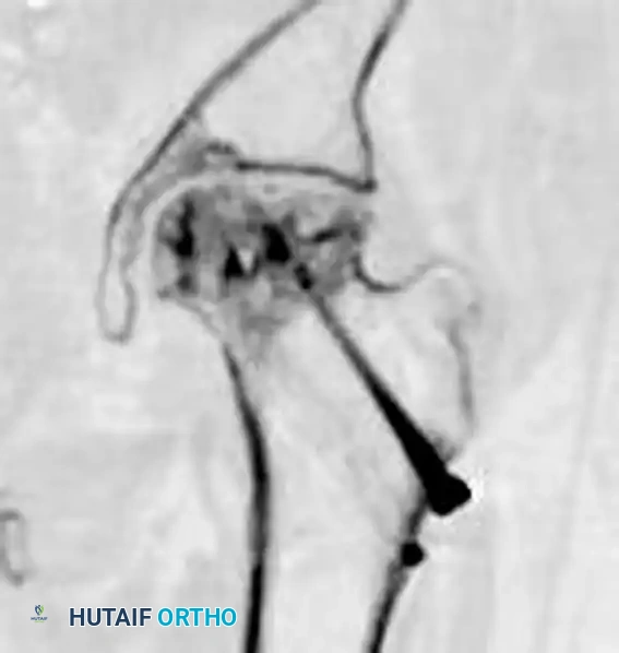 INTERTROCHANTERIC FEMORAL FRACTURES Surgical Diagram