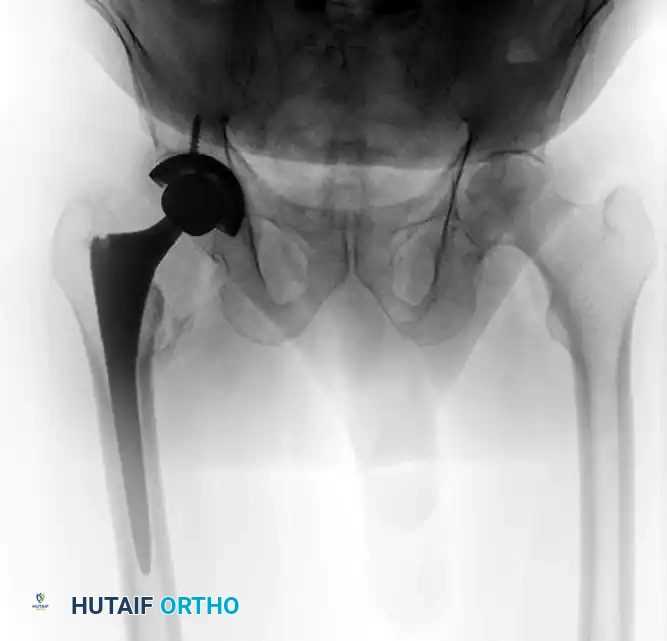 INTERTROCHANTERIC FEMORAL FRACTURES Surgical Diagram