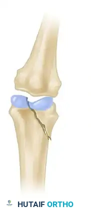 INTRAARTICULAR FRACTURES Surgical Diagram