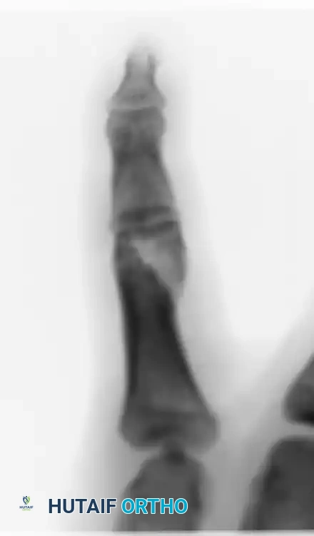 INTRAARTICULAR FRACTURES Surgical Diagram