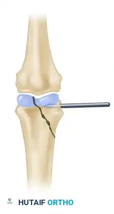 INTRAARTICULAR FRACTURES Surgical Diagram