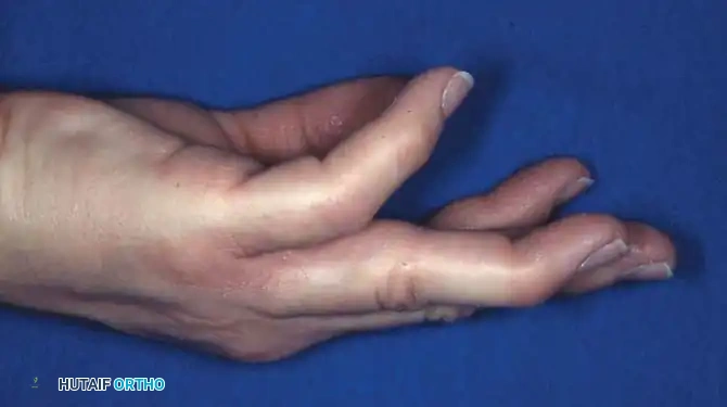 Fig. 64-64 A, Acute type 1 mallet fi nger with secondary “swanning” of proximal interphalangeal joint. B, Aluminum splint achieving full extension of distal interphalangeal joint.