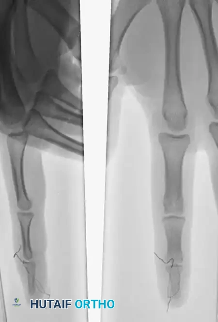 Fig. 64-65 A, Type 4 mallet fi nger in high school basketball player. B, Results of pull-out wire and pin fi xation of distal interphalangeal joint just before pin removal at 4 weeks. C, Pull-out wire left in until 6 weeks after surgery.