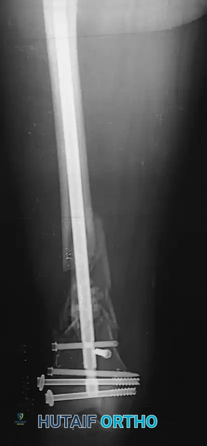 FIGURE 53-36 Dynamic (A) and static (B) locking of intramedul lary nail.