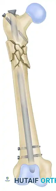 INTRAMEDULLARY NAIL FIXATION Surgical Diagram