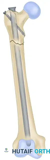 INTRAMEDULLARY NAIL FIXATION Surgical Diagram