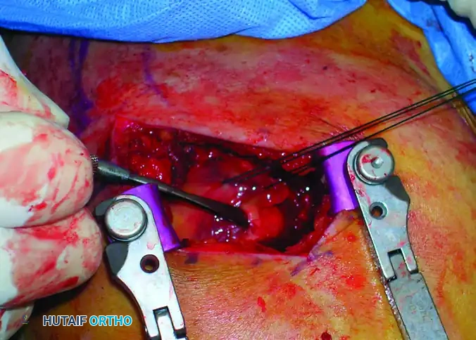 Intramedullary Nailing of Proximal Humeral Fractures