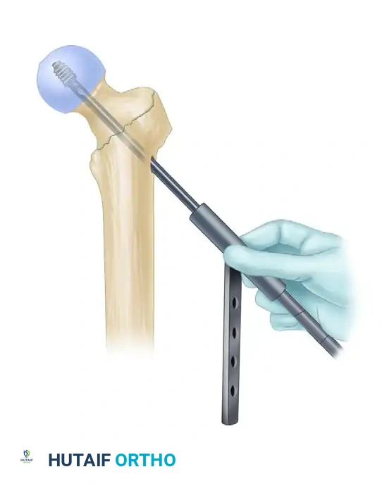 INTRAMEDULLARY NAILING OF INTERTROCHANTERIC FEMORAL FRACTURES Surgical Diagram