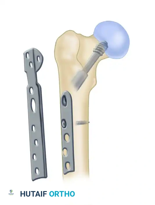 FIGURE 55-33 Modified medial trochanteric portal.