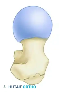 INTRAMEDULLARY NAILING OF INTERTROCHANTERIC FEMORAL FRACTURES Surgical Diagram