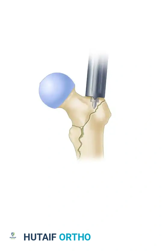 E, Measurement for length of lag screw.