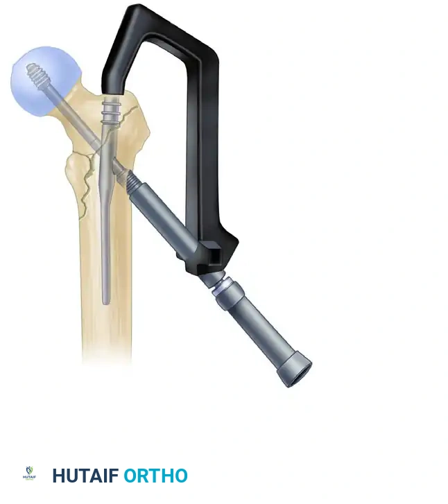 H, Insertion of centering sleeve.