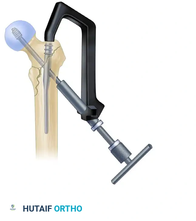 G, Insertion of lag screw.