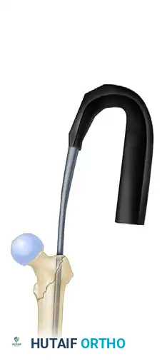 INTRAMEDULLARY NAILING OF INTERTROCHANTERIC FEMORAL FRACTURES WITH INTEGRATED PROXIMAL INTERLOCKING SCREWS (INTERTAN) Surgical Diagram