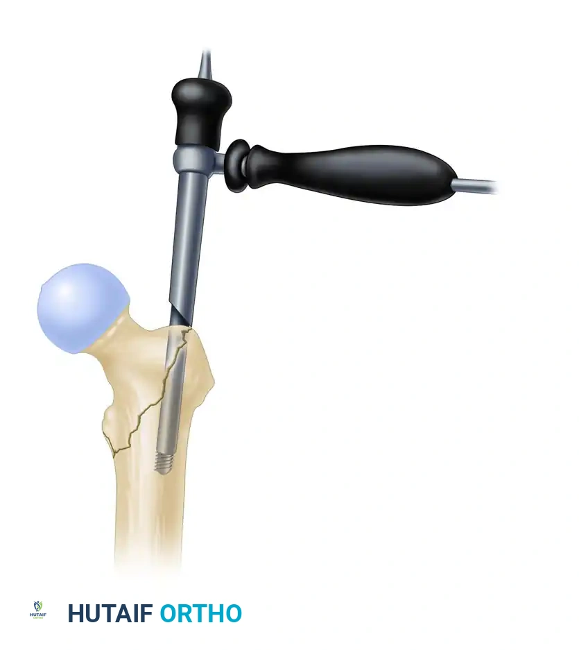 INTRAMEDULLARY NAILING OF INTERTROCHANTERIC FEMORAL FRACTURES WITH INTEGRATED PROXIMAL INTERLOCKING SCREWS (INTERTAN) Surgical Diagram