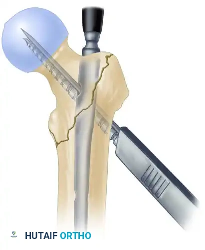 INTRAMEDULLARY NAILING OF INTERTROCHANTERIC FEMORAL FRACTURES WITH INTEGRATED PROXIMAL INTERLOCKING SCREWS (INTERTAN) Surgical Diagram