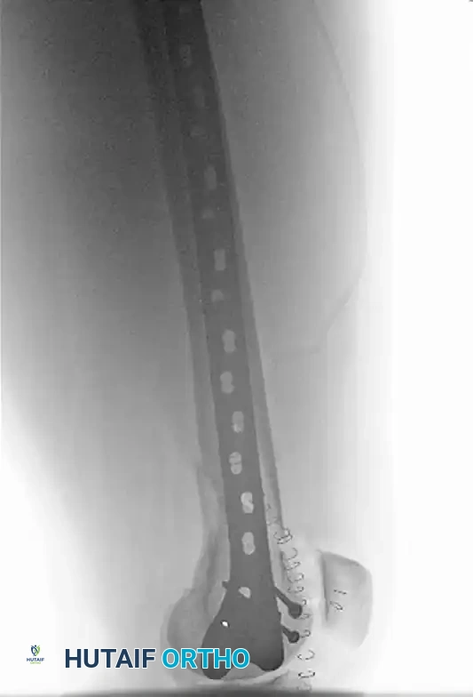 INTRAMEDULLARY NAILING Surgical Diagram