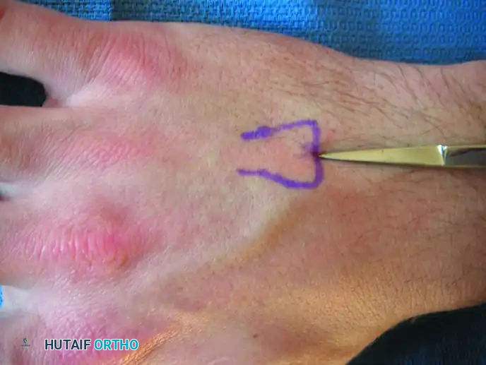 Intramedullary Pinning of Metacarpal Shaft Fractures: A Master Surgical Guide