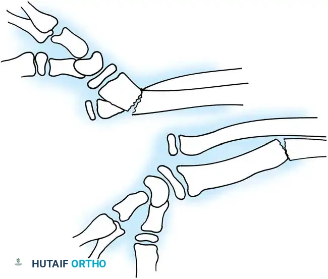 Operative Management of Radial Head Dislocations & Galeazzi Fractures