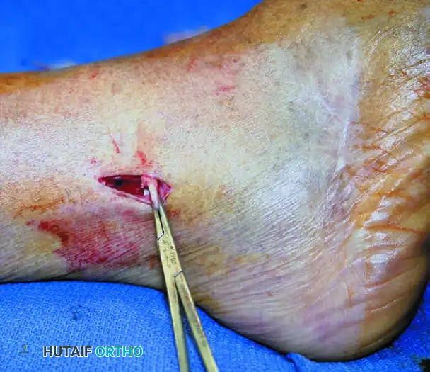 ISOLATED MEDIAL INCISION FOR TRIPLE ARTHRODESIS Surgical Diagram