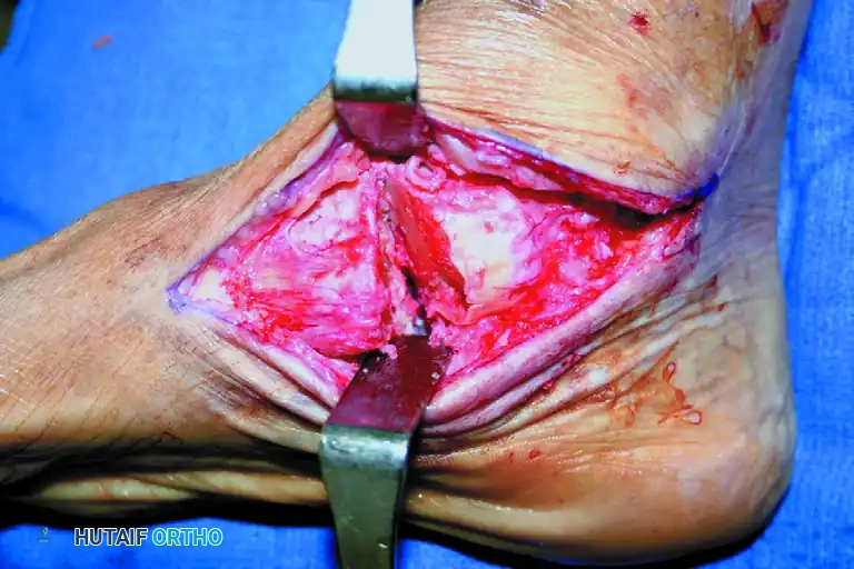 ISOLATED MEDIAL INCISION FOR TRIPLE ARTHRODESIS Surgical Diagram