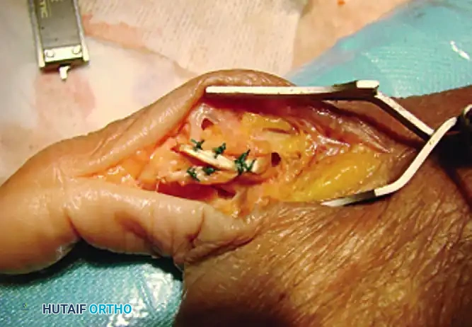 JOBE FOUR-LIMB RECONSTRUCTION Surgical Diagram