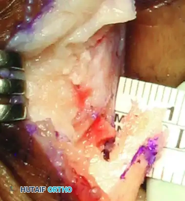 JOHNSON MODIFIED CHEVRON OSTEOTOMY Surgical Diagram