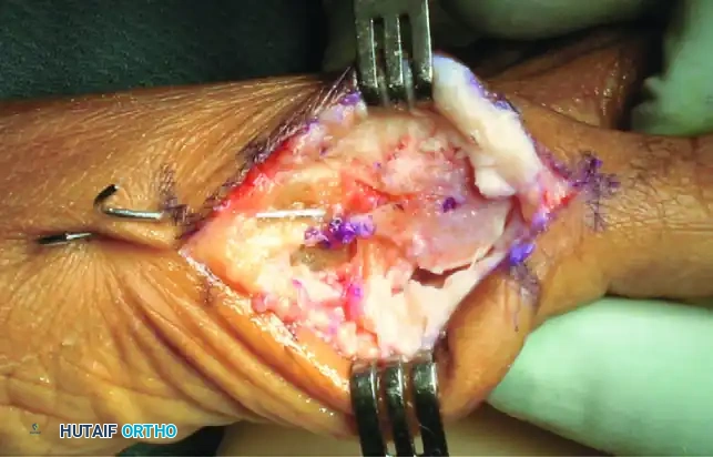 JOHNSON MODIFIED CHEVRON OSTEOTOMY Surgical Diagram
