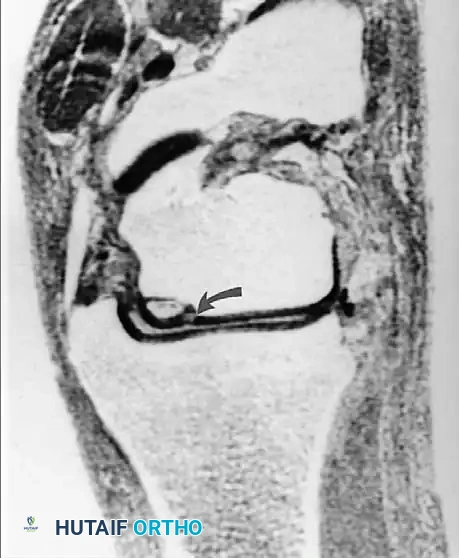 صورة مقطعية تظهر السوائل حول الجزء العظمي المنفصل