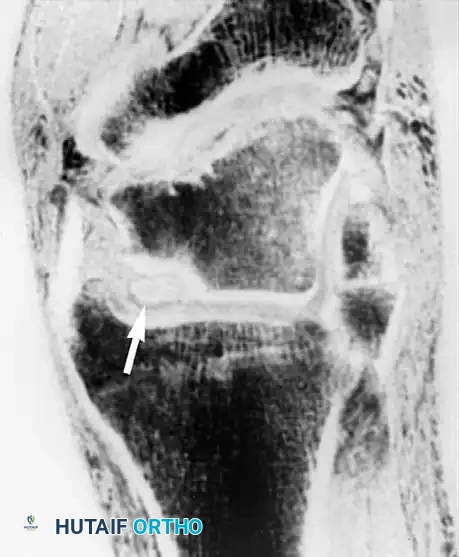 صورة توضح عيب الغضروف المفصلي المؤكد بالمنظار