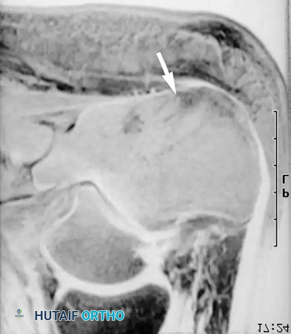صورة رنين مغناطيسي تظهر زيادة في الإشارة تدل على التهاب العظم في الكعب