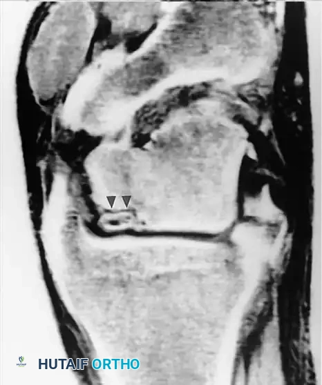 الدليل الشامل لتشخيص وعلاج إصابات الركبة بالرنين المغناطيسي والجراحة