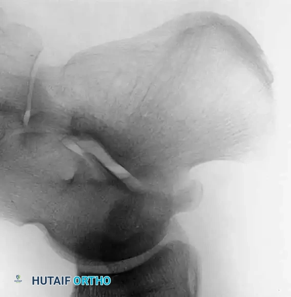 صورة أشعة سينية جانبية للقدم لا تظهر تشوهات واضحة